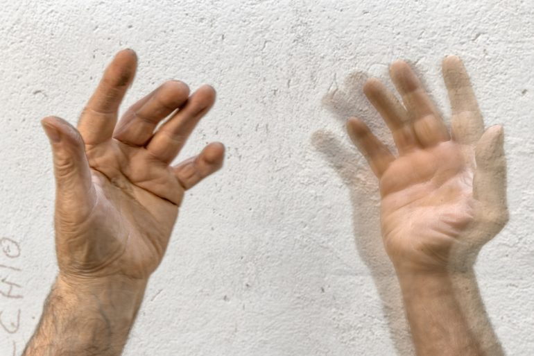 Mani di un malato di Parkinson. Foto di Giovanni Diffidenti